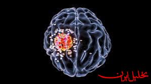  تحلیل ایران -نانوذرات گیاهی با سرطان مرگبار مغز مقابله می کند