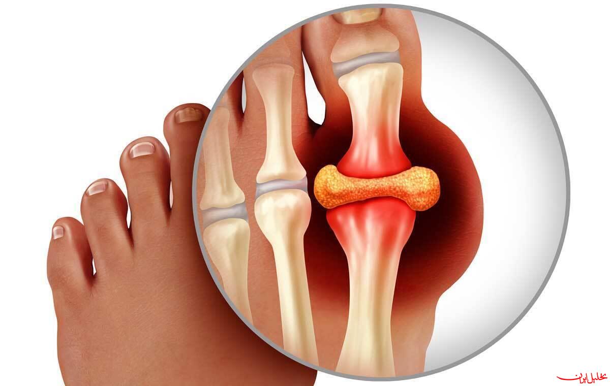  تحلیل ایران -سیر تا پیاز بیماری نقرس؛ کدام افراد درگیر این بیماری می‌شوند؟