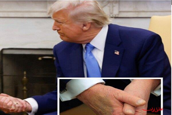  تحلیل ایران -ابتلای ترامپ به «نارسایی مزمن وریدی»