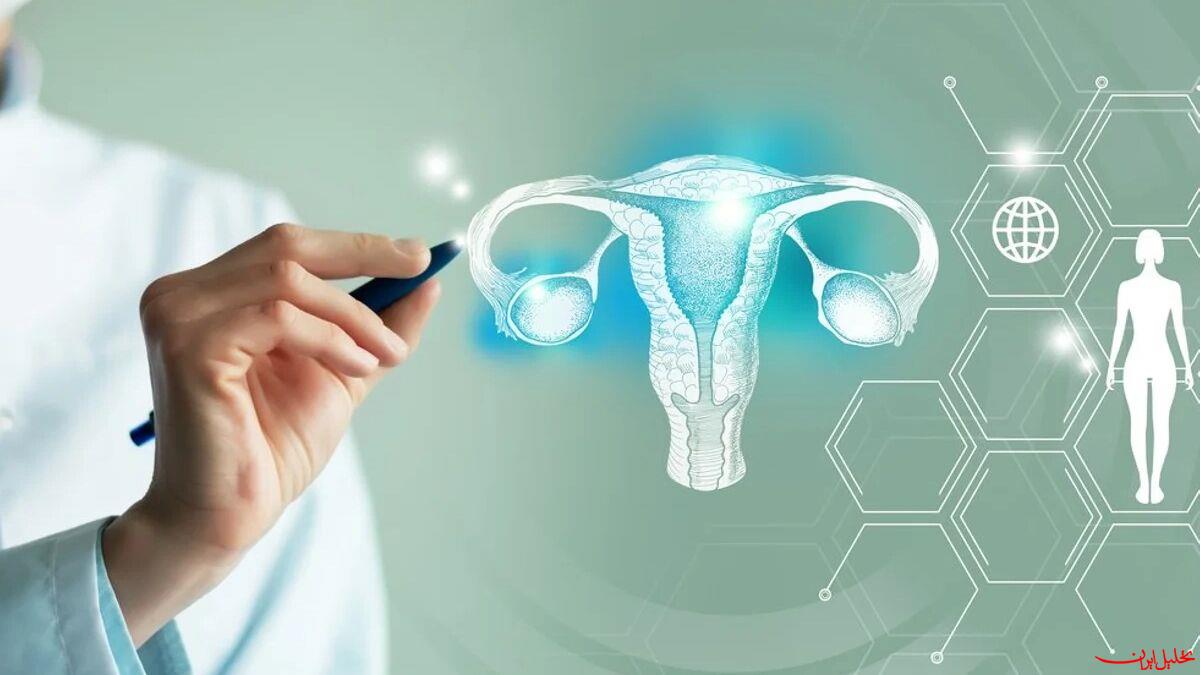  تحلیل ایران -کشف عامل جدید گسترش سرطان تخمدان